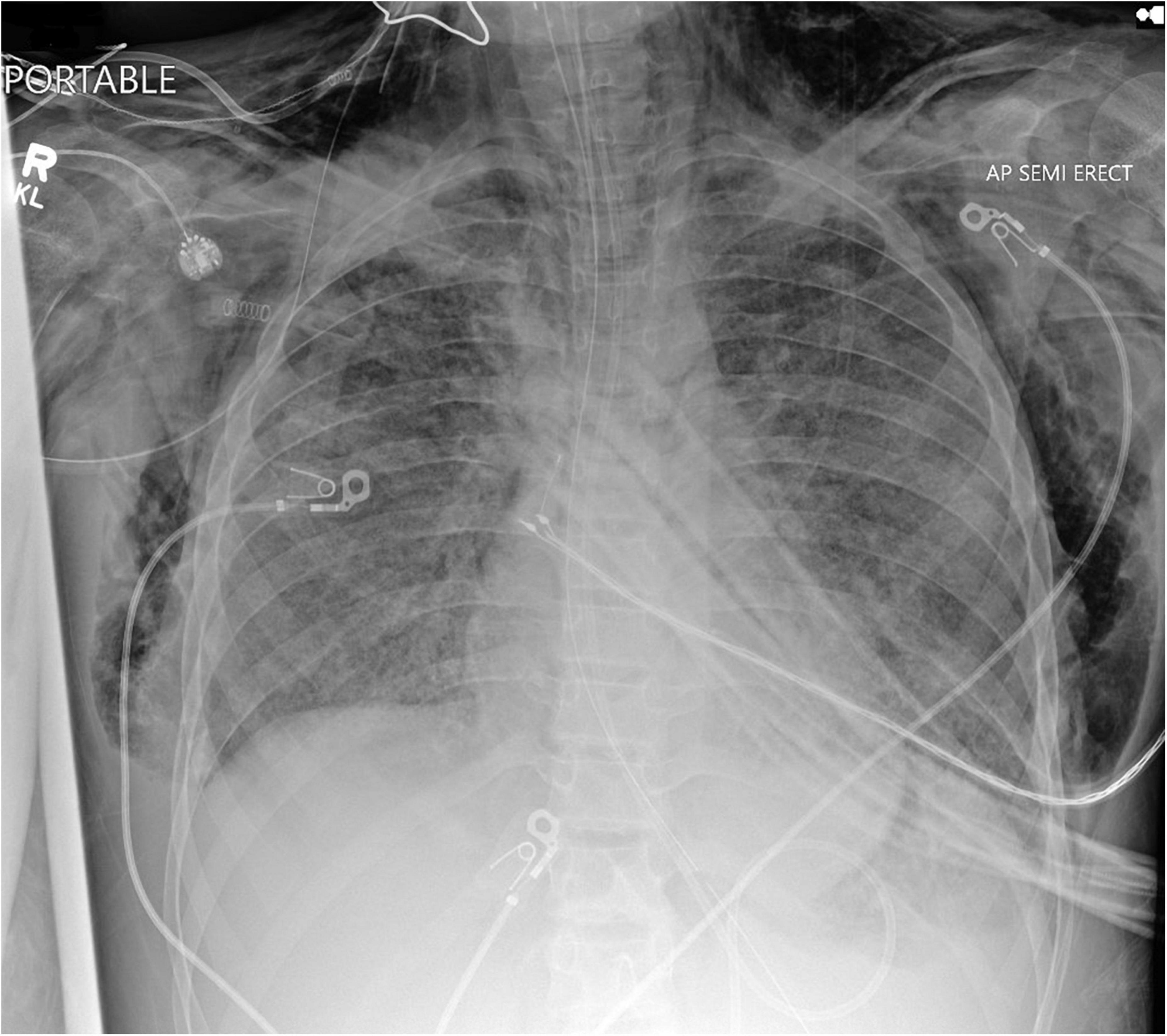 Complications during mechanical ventilation—A pediatric intensive care perspective